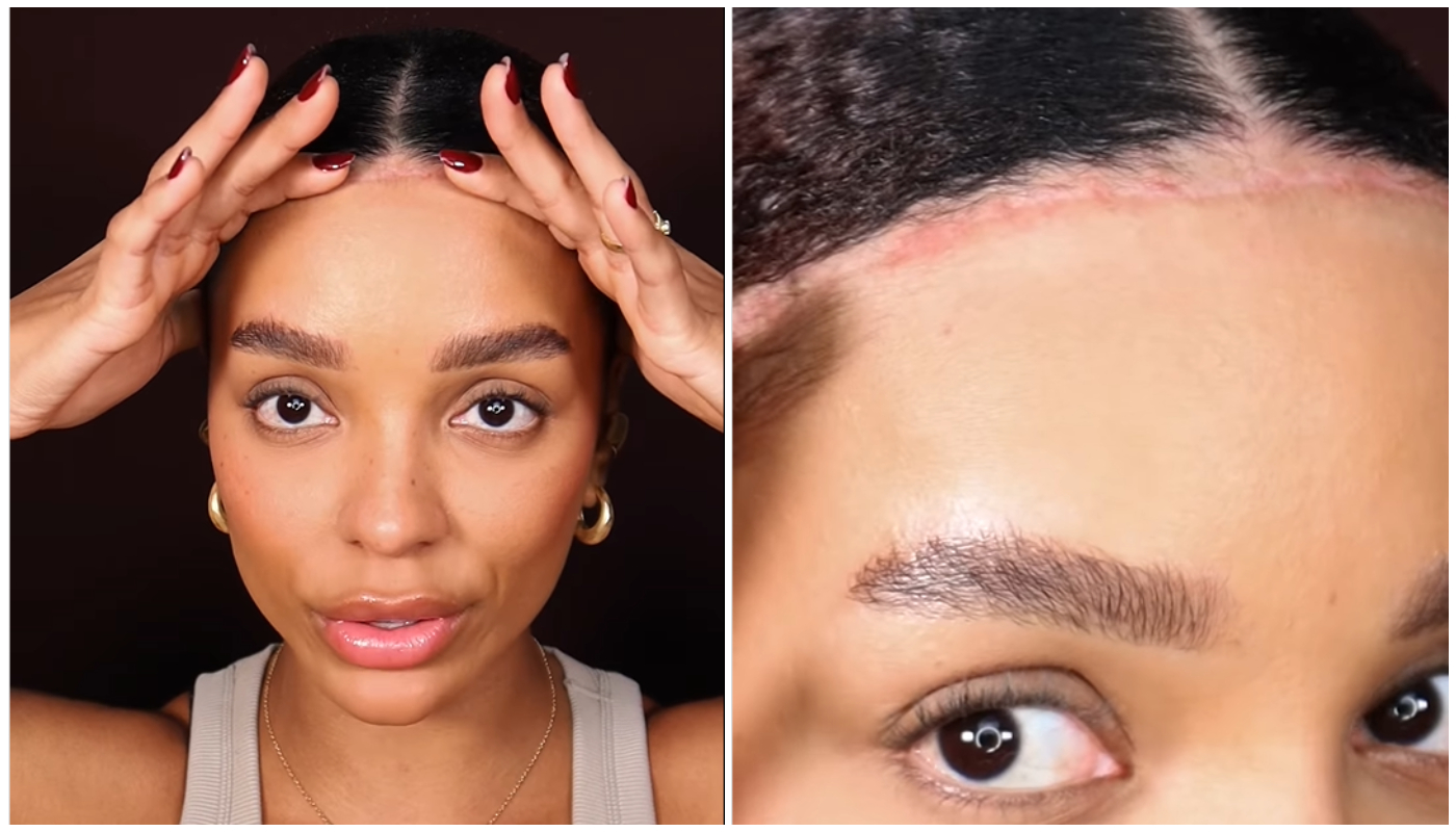 Brunna Gonçalves mostra cicatriz de cirurgia de redução de testa e revela que “lixou” a região: “Mais livre e segura”