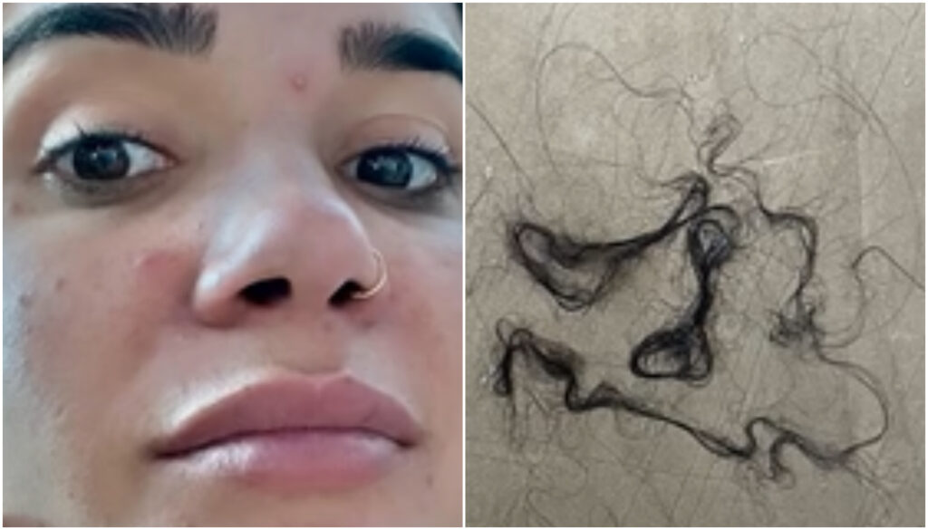 No período em que fez uso de anabolizantes, Gizelly Bicalho apresentou queda de cabelo e acne na região do rosto