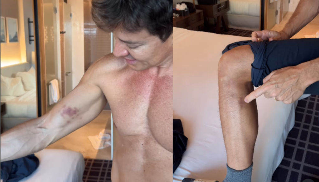 Rodrigo Faro exibe hematomas. (Créditos: Reprodução / @rodrigofaro)