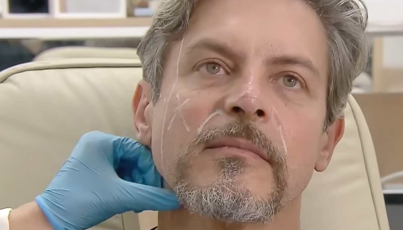 Luigi Baricelli mostra resultado de harmonização facial