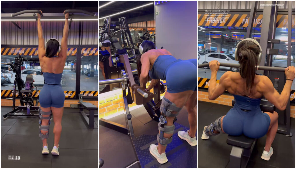 Gracyanne Barbosa pós cirurgia