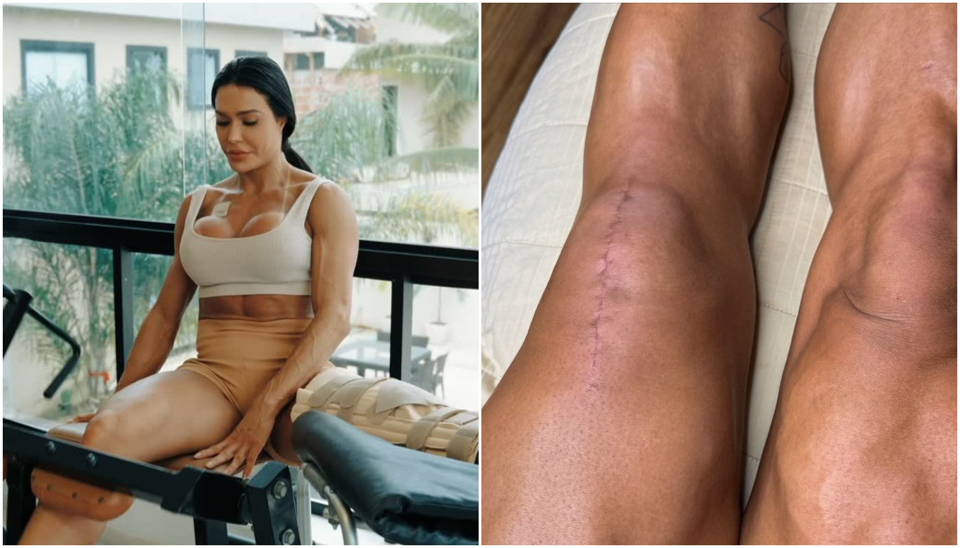 Gracyanne mostra cicatriz de cirurgia no joelho: “Parte de uma vitória”