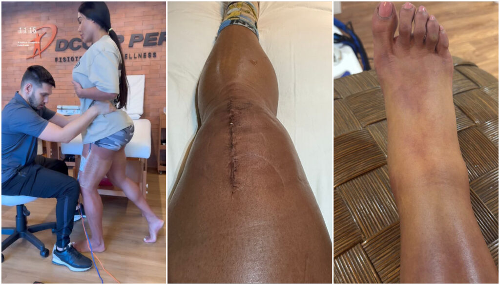 Seguidores já questionam se Gracyanne irá tratar ou tentar tirar a cicatriz, mas o foco da musa fitness é outro