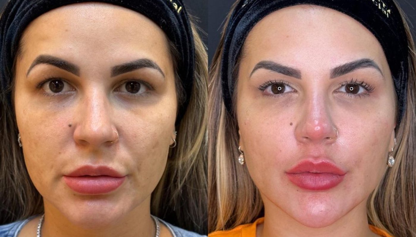 Deolane Bezerra retirou preenchimento e fez nova harmonização facial: veja o antes e depois