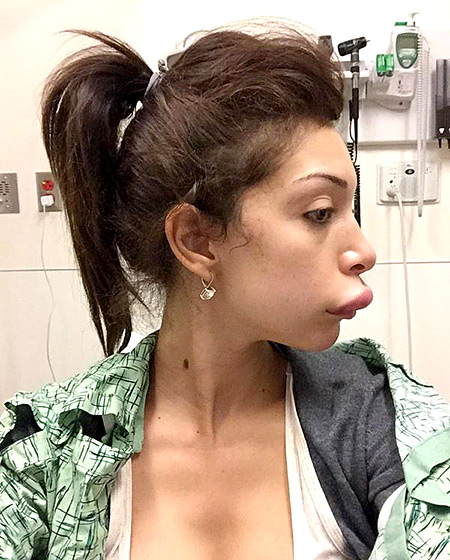 11 desastres de cirurgia plástica que afetaram até famosas