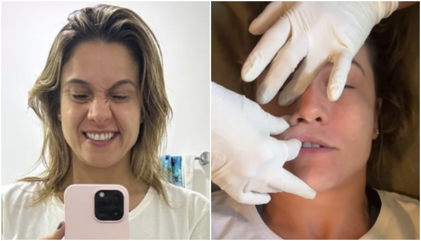 Fernanda Gentil mostra paralisia facial (à esquerda) e tratamento (à direita)